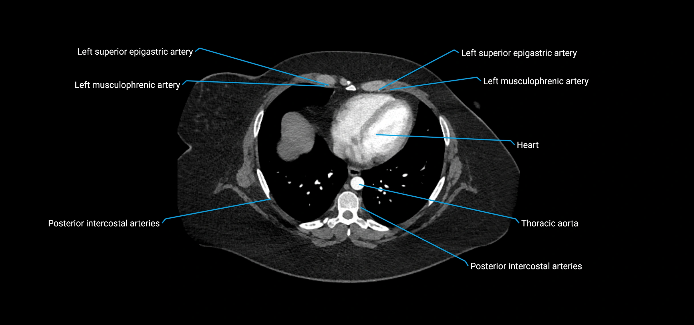 CTA abdomen axial cross sectional anatomy labelled image_6 (1).webp